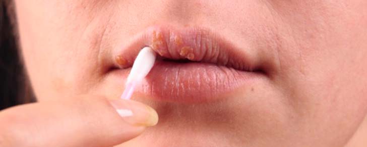 Як лікувати потріскані губи