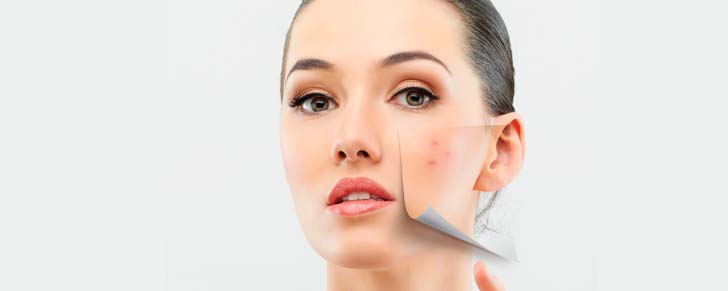 Як позбутися від дефектів шкіри: акне